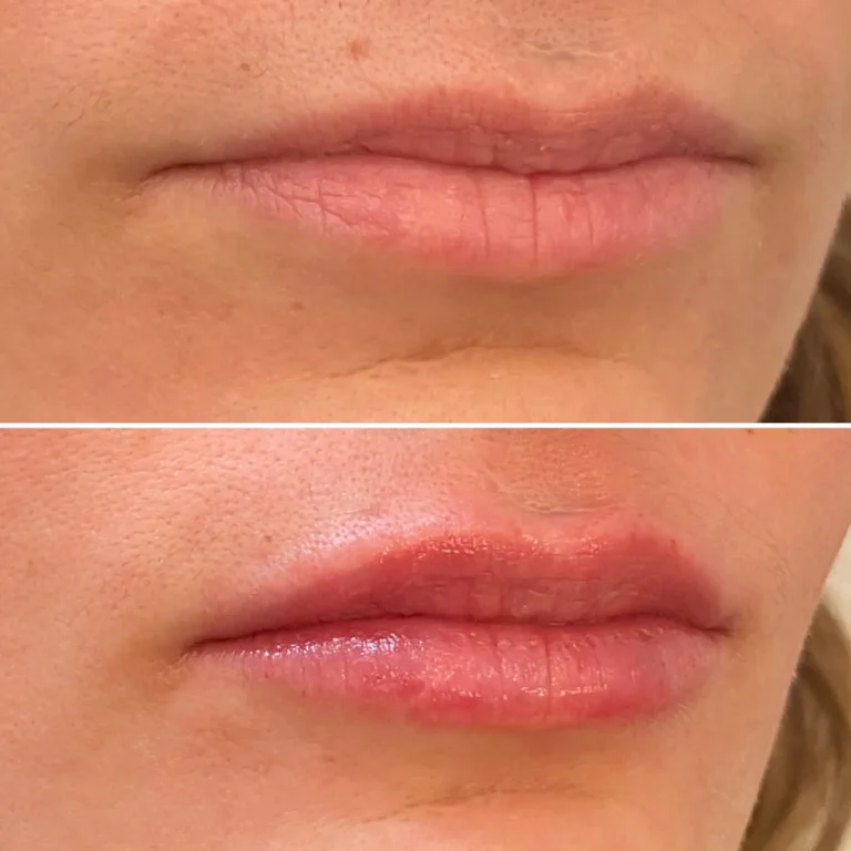 Acide-hyaluronique-levres-paris