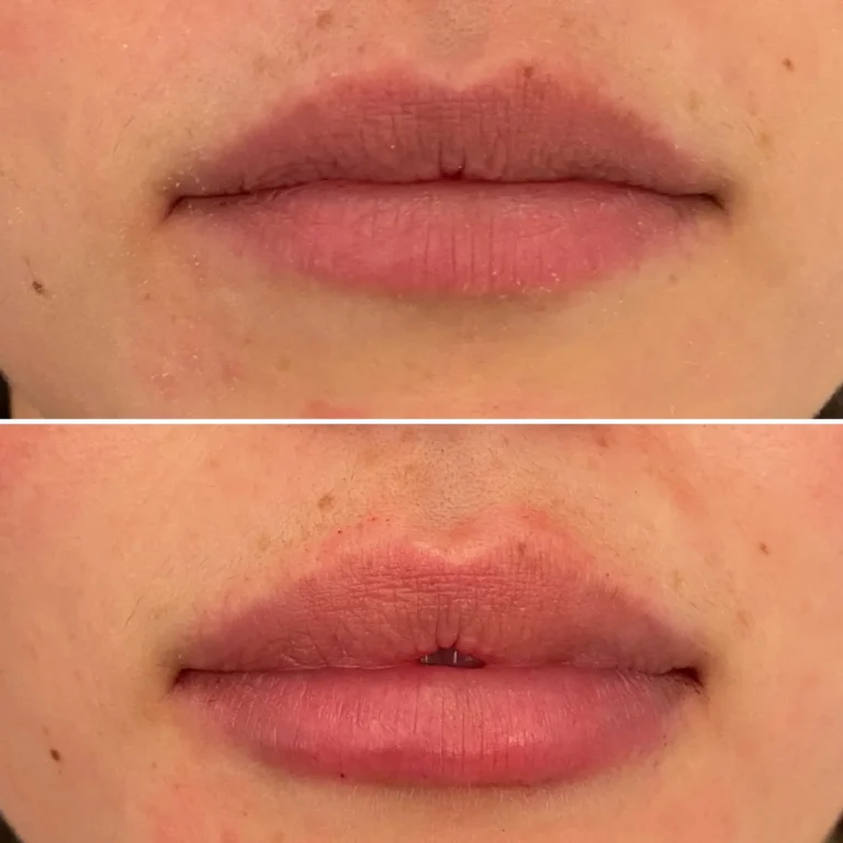 Augmenter-levres-paris