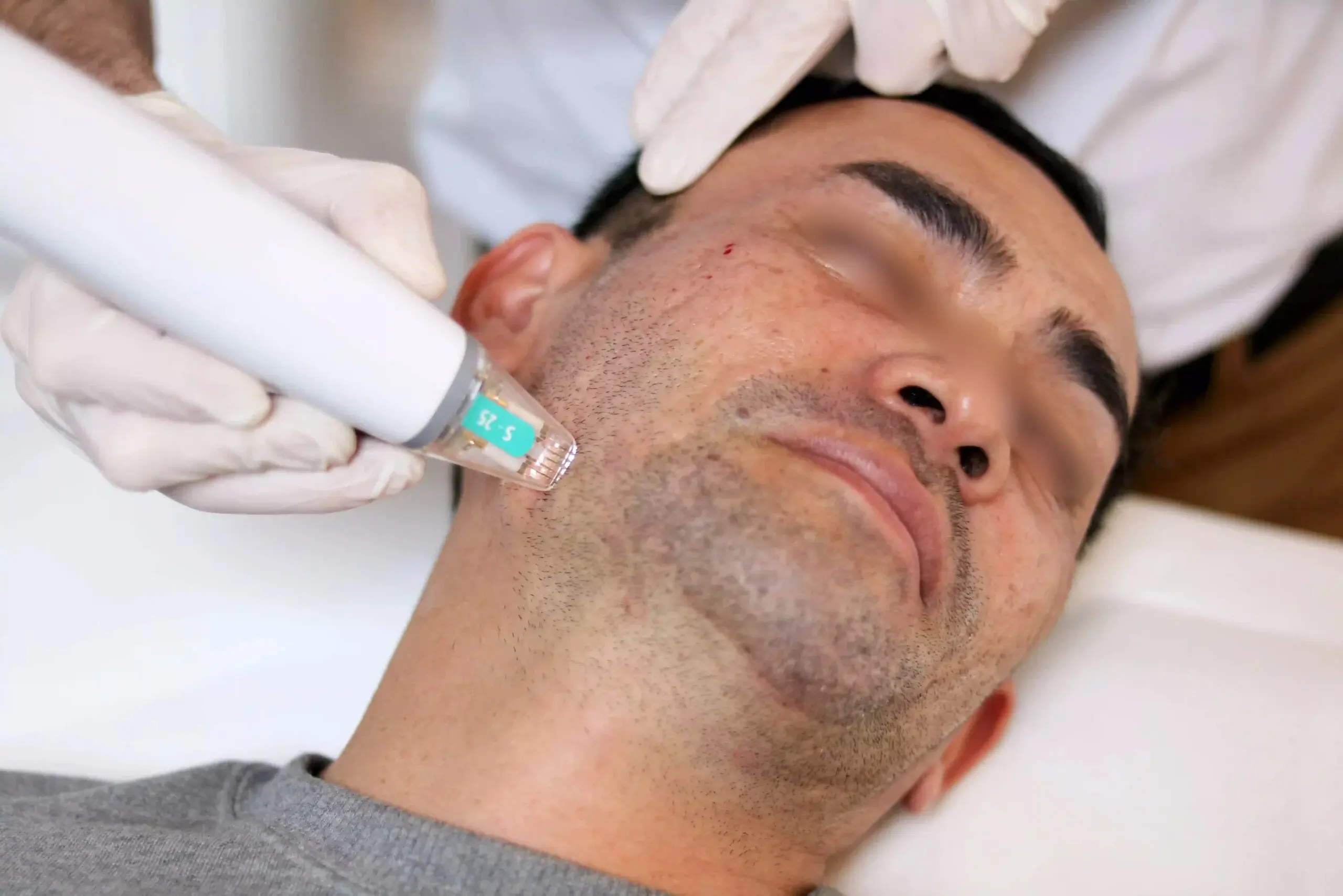 Traitement des cicatrices d'acnée au centre esthétique du dr julien vivier