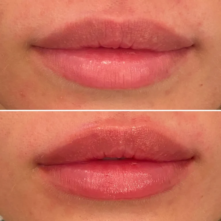 acide-hyaluronique-levre-paris