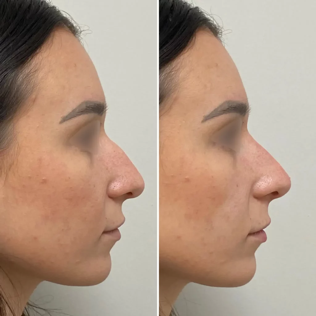 traitement de rhinoplastie avant après docteur julien vivier paris