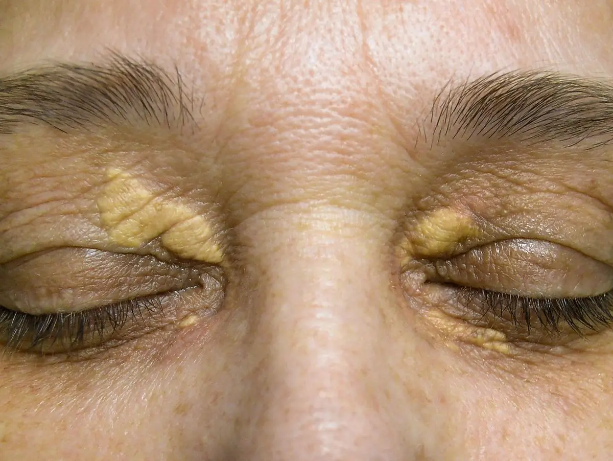 Traitement des Xanthélasmas par PLexR au centre esthétique du docteur julien vivier à Paris