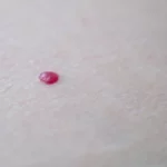 angiome sur la peau