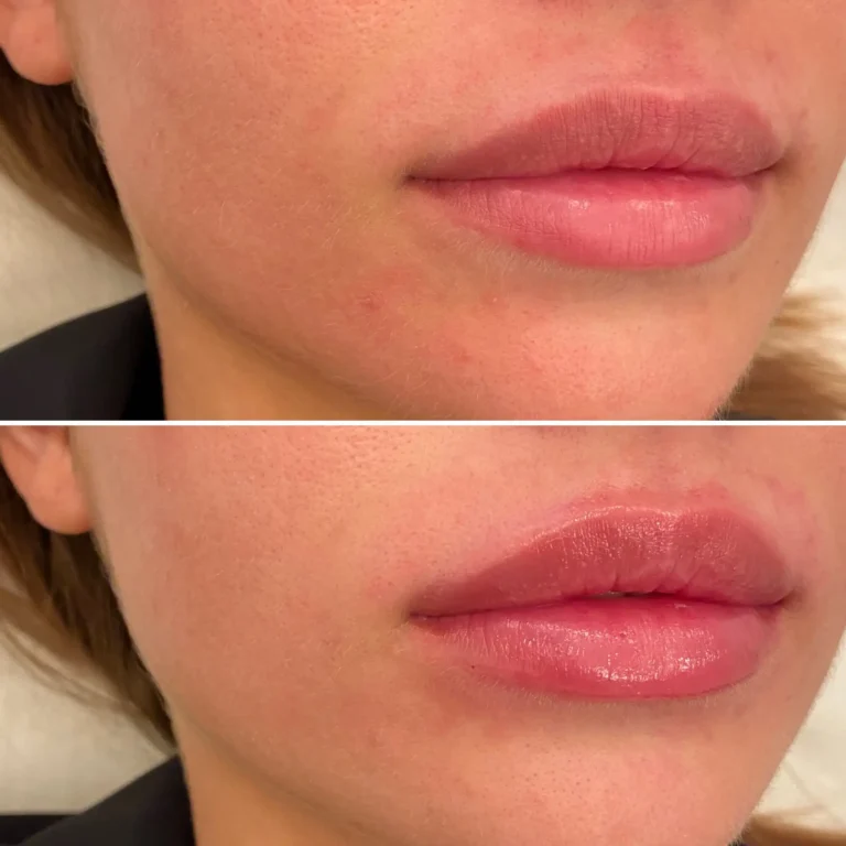 injection-acide-hyaluronique-paris