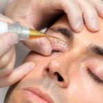 la plasma exérèse en médecine esthétique