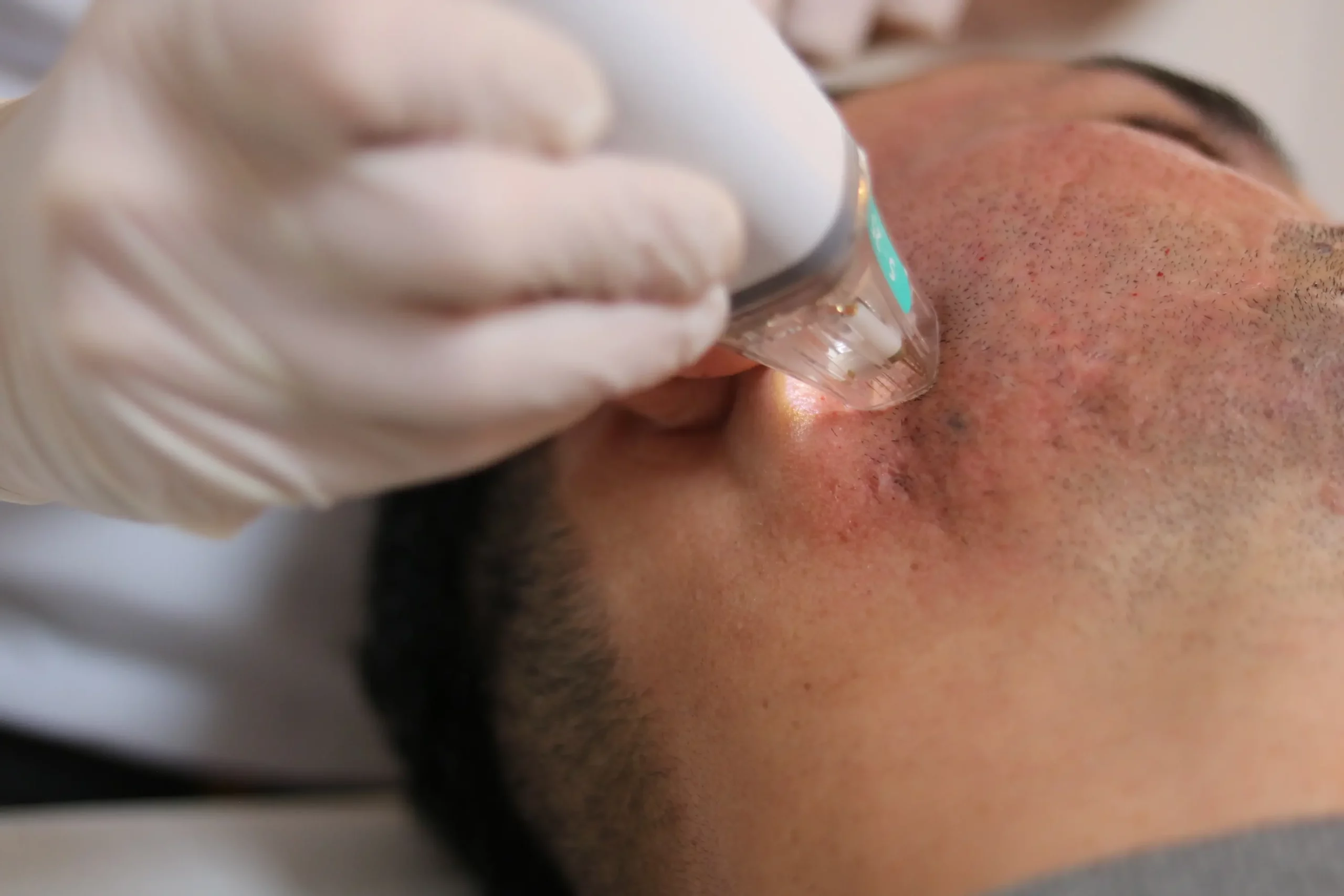 Traitement des cicatrices d'acnées sur le visage d'un homme