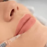 injections des lèvres au cabinet du docteur julien vivier paris