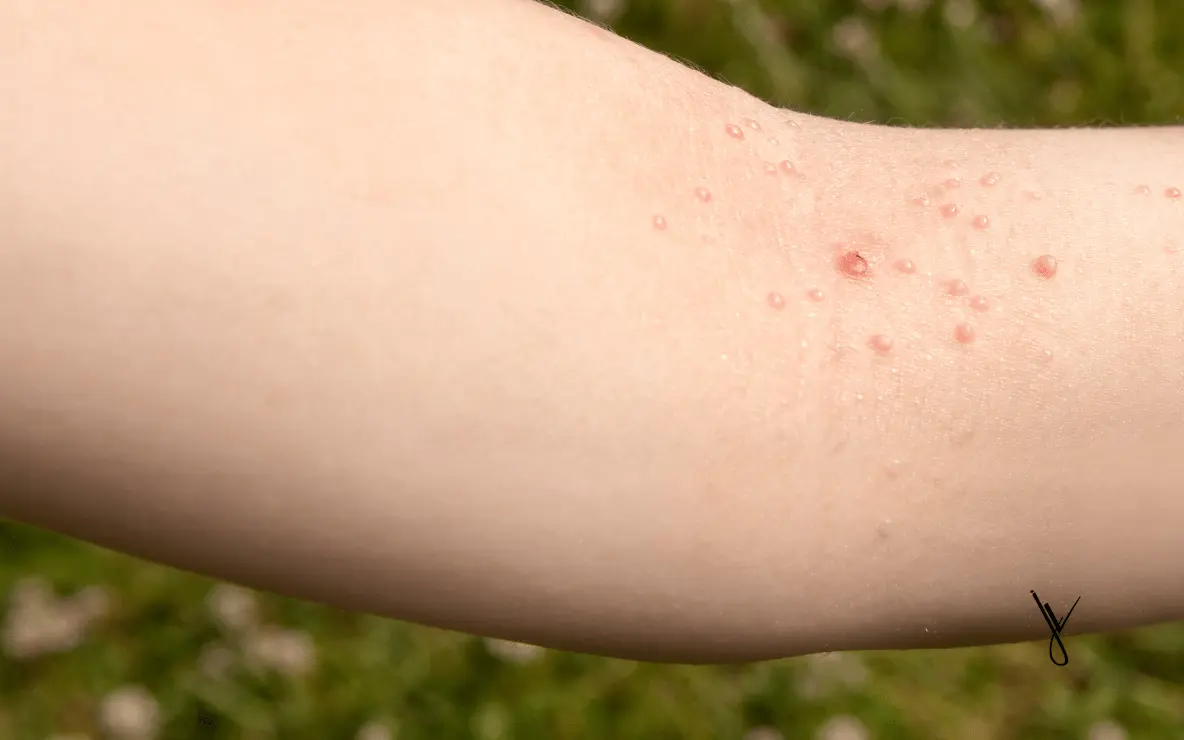 image représentant des petites excroissances cutanées appelé Molluscum Contagiosum