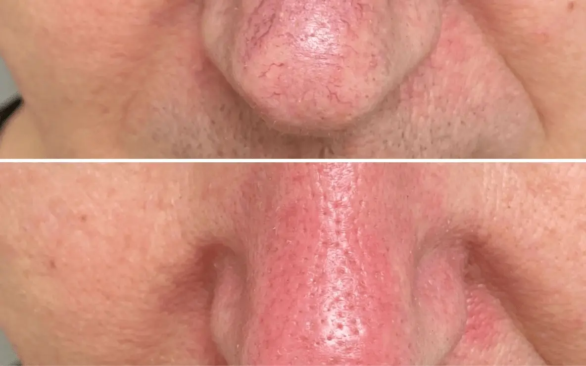 Traitement couperose au centre esthétique du docteur julien vivier à Paris