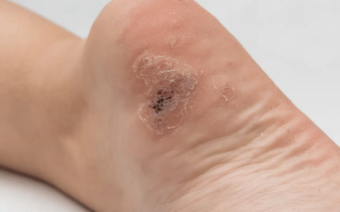 traitement des verrues plantaires de type mosaïques à paris au cabinet du docteur julien vivier