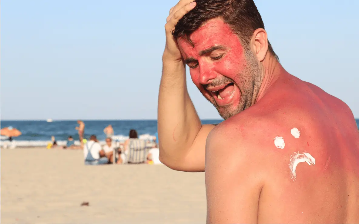 photo d'un homme avec des coups de soleil