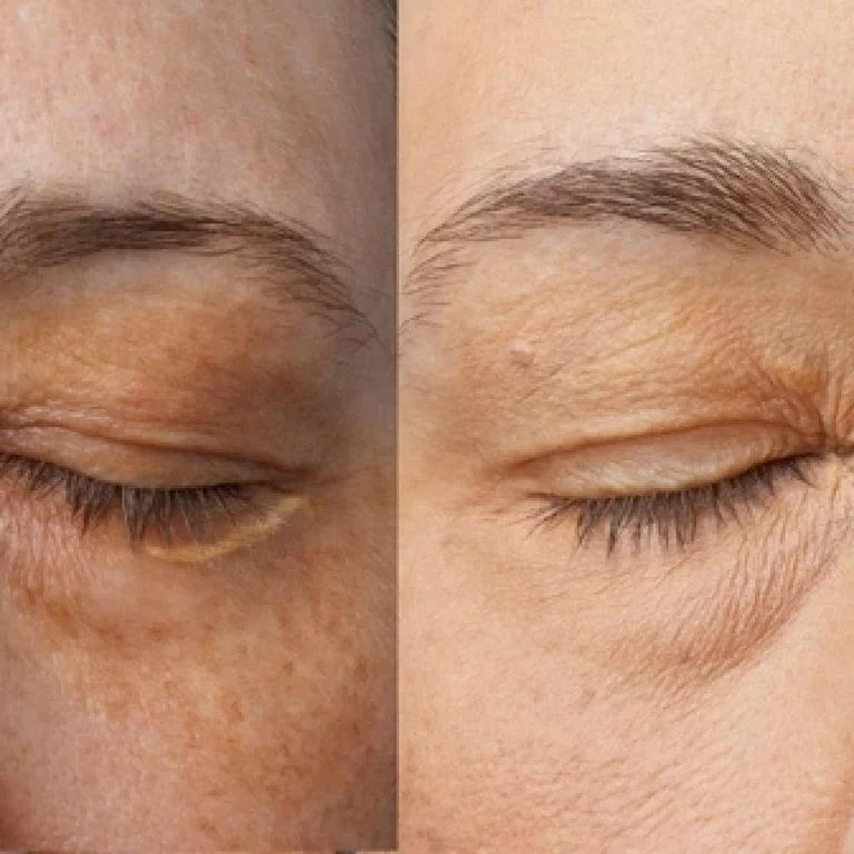 Traitement des Xanthélasmas par PLexR avant-apres