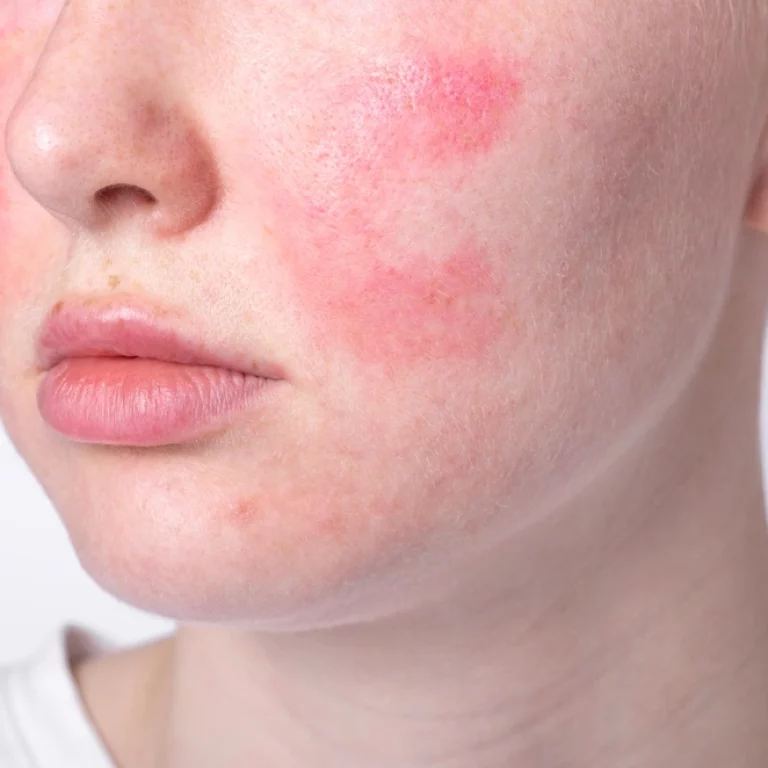 traitement couperose au centre esthétique du docteur julien vivier à Paris