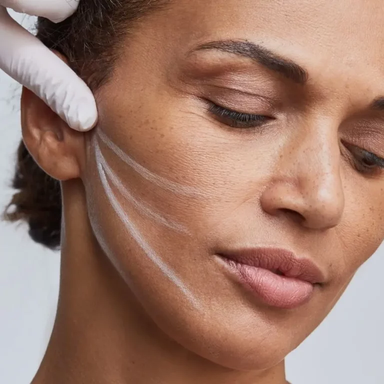 Image d'une femme pour le traitement des fils tenseurs au cabinet du docteur julien vivier à Paris