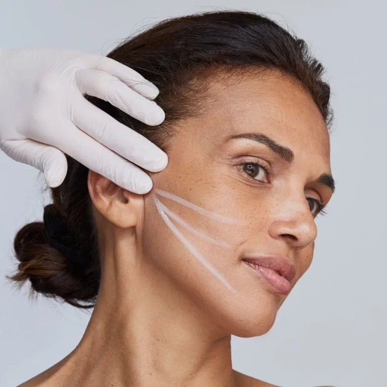 fils tenseurs resorbables technologie au centre esthétique du dr julien vivier Paris-Lyon