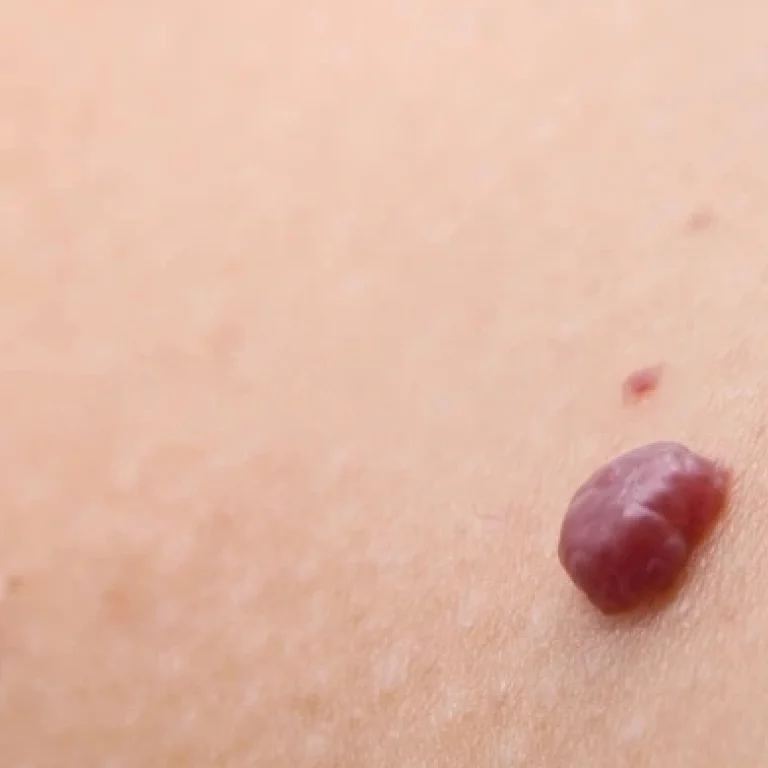 Traitement de l'angiome au centre esthétique du docteur julien vivier à Paris