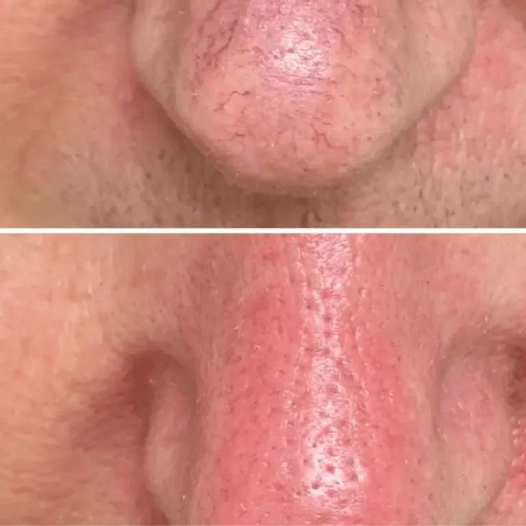 Traitement couperose au centre esthétique du docteur julien vivier à Paris