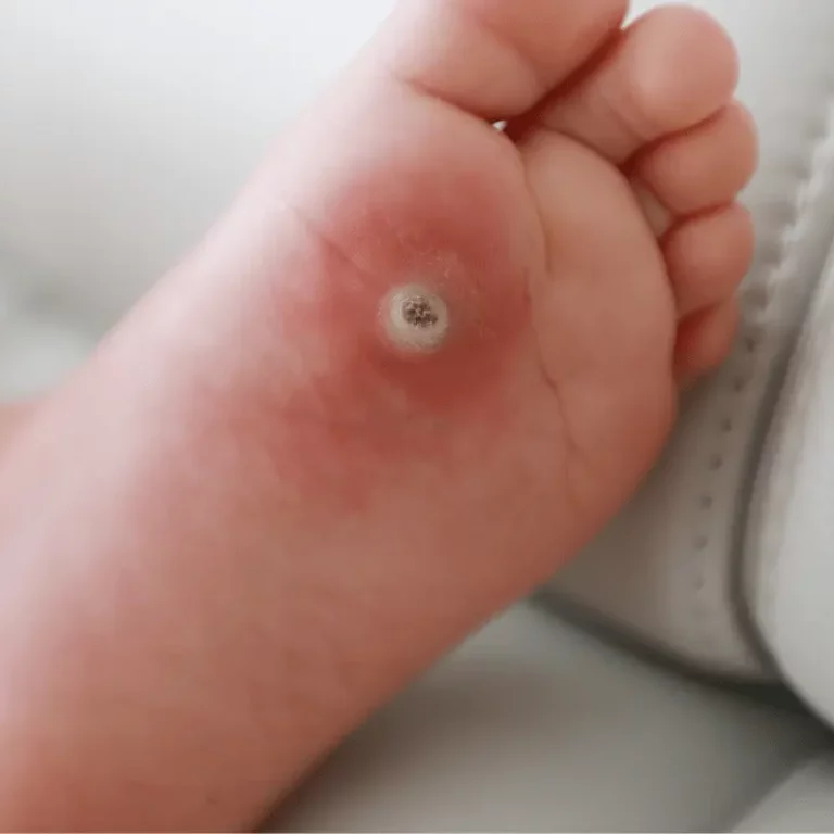 Image représentant une verrue plantaire.